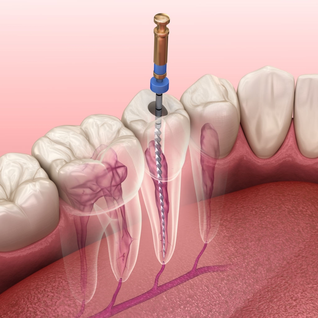 root-canal-treatment-in-thanjavur-dhavam-dental-clinic